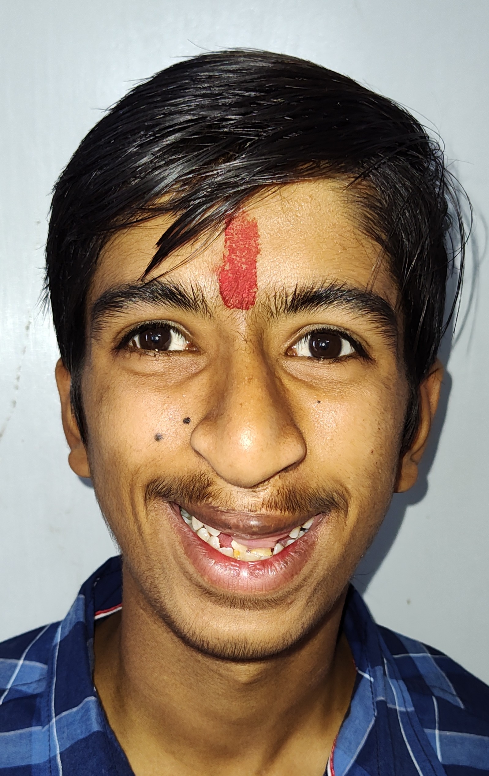 Severe Maxillary Retrusion in Bilateral Cleft Patient - Before Surgical Orthodontics